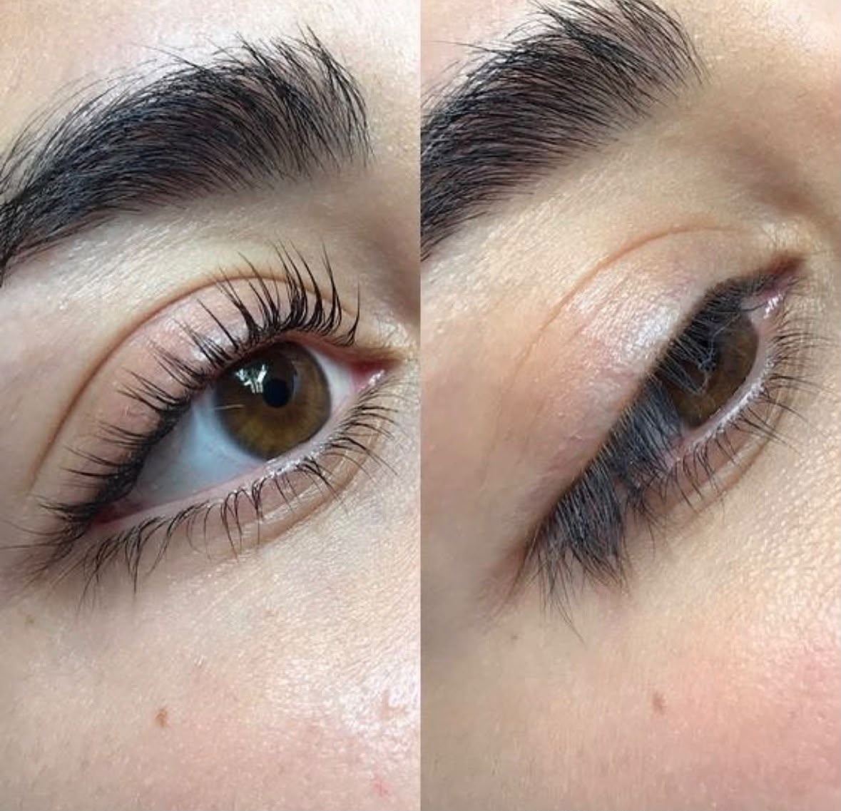Antes y después de un tratamiento en el Centro de Estética Milenium
