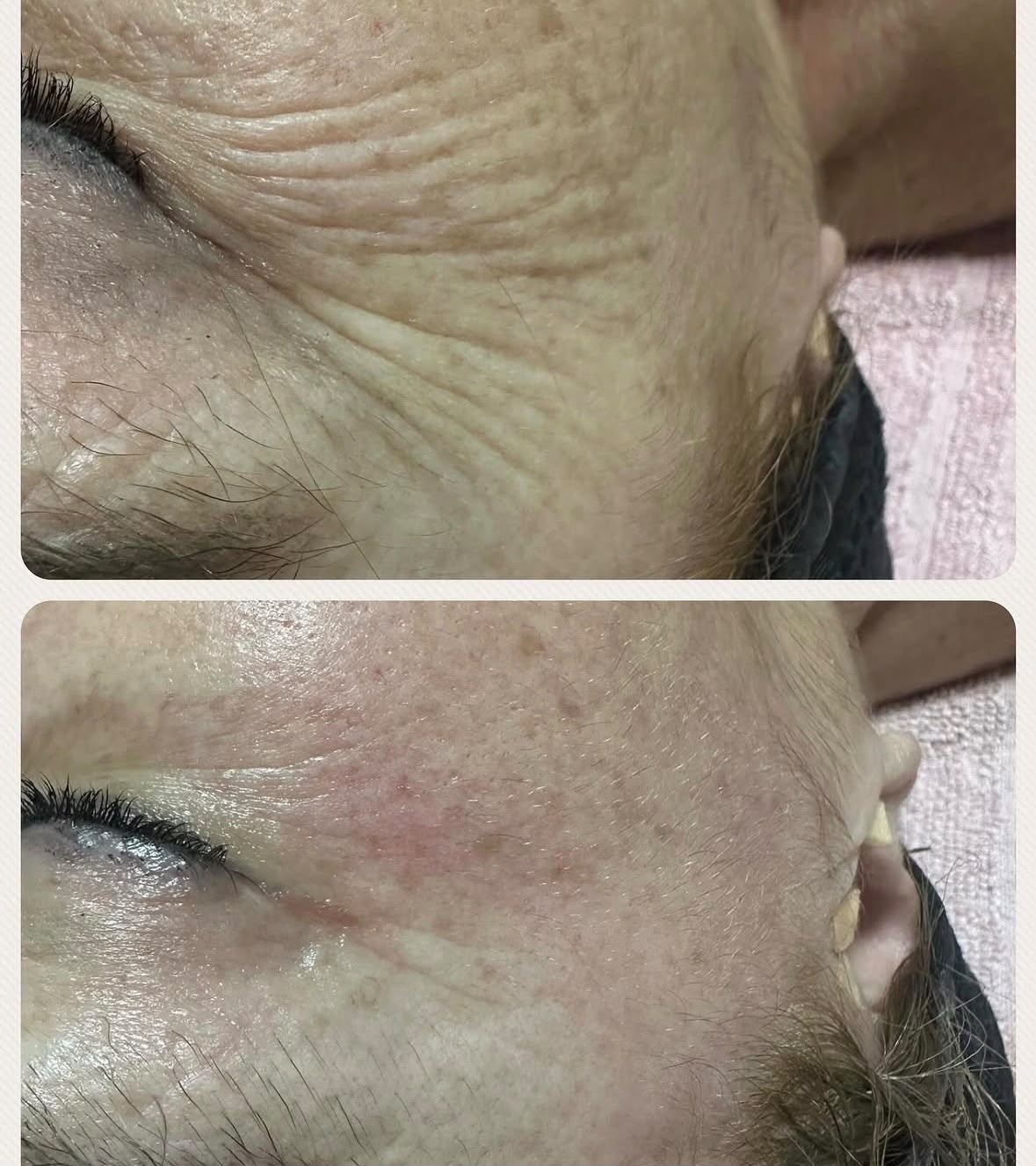 Antes y después de un tratamiento en el Centro de Estética Milenium